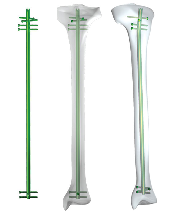 Biomet Tibial Nail